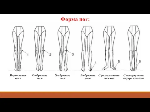 Форма ног: Нормальные ноги О-образные ноги Х-образные ноги Л-образные ноги С разведенными