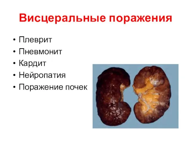 Висцеральные поражения Плеврит Пневмонит Кардит Нейропатия Поражение почек