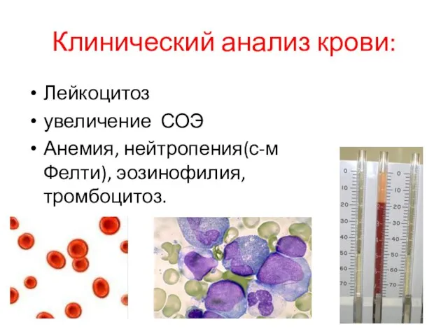 Клинический анализ крови: Лейкоцитоз увеличение СОЭ Анемия, нейтропения(с-м Фелти), эозинофилия, тромбоцитоз.