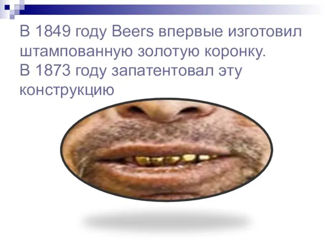 В 1849 году Beers впервые изготовил штампованную золотую коронку. В 1873 году запатентовал эту конструкцию