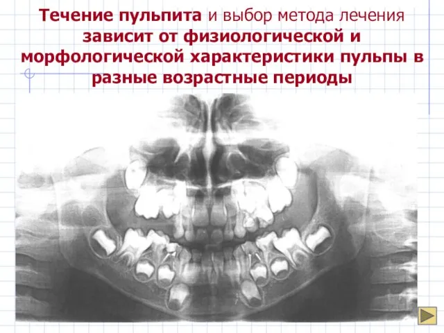 Течение пульпита и выбор метода лечения зависит от физиологической и морфологической характеристики