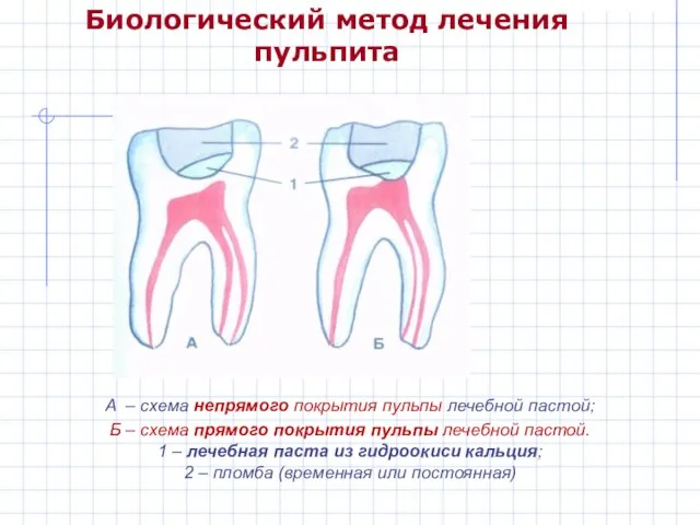 Биологический метод лечения пульпита А – схема непрямого покрытия пульпы лечебной пастой;