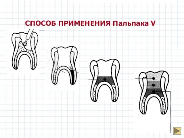 СПОСОБ ПРИМЕНЕНИЯ Пальпака V