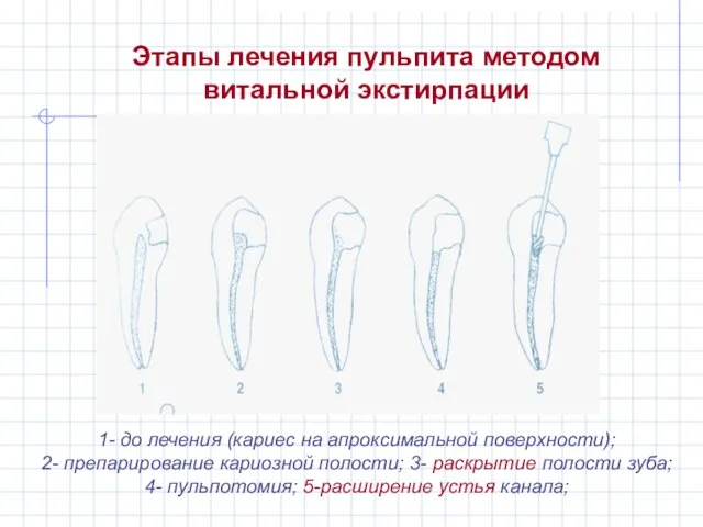 Этапы лечения пульпита методом витальной экстирпации 1- до лечения (кариес на апроксимальной