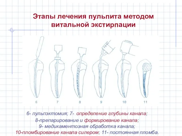 Этапы лечения пульпита методом витальной экстирпации 6- пульпэктомия; 7- определение глубины канала;