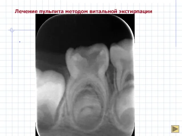 Лечение пульпита методом витальной экстирпации