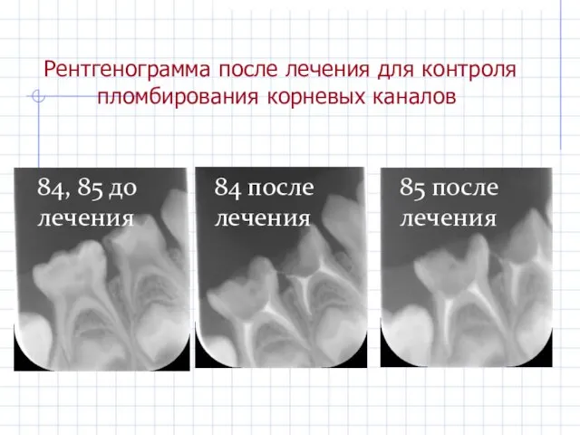 Рентгенограмма после лечения для контроля пломбирования корневых каналов 84, 85 до лечения