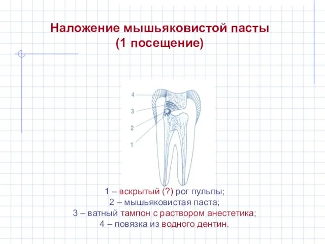 Наложение мышьяковистой пасты (1 посещение) 1 – вскрытый (?) рог пульпы; 2