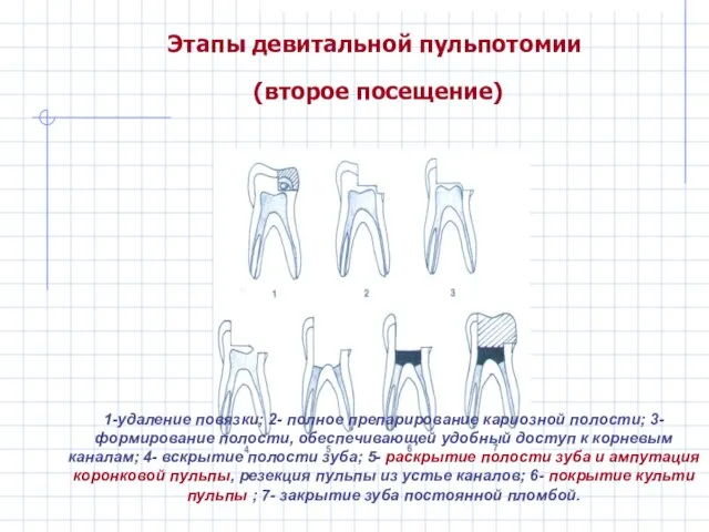 Этапы девитальной пульпотомии (второе посещение) 1-удаление повязки; 2- полное препарирование кариозной полости;