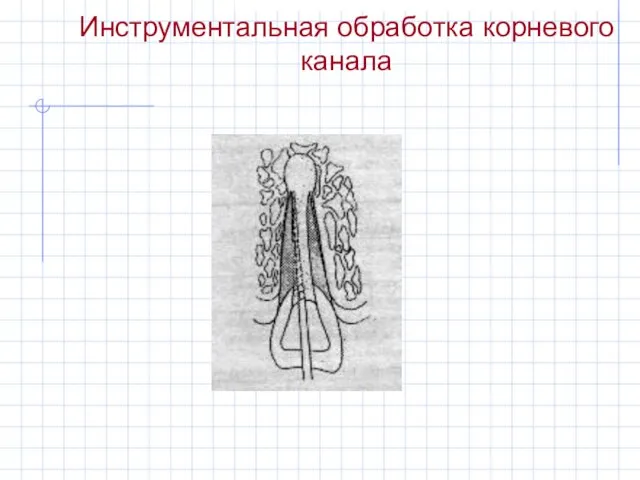 Инструментальная обработка корневого канала