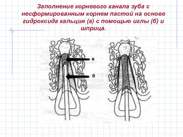 Заполнение корневого канала зуба с несформированным корнем пастой на основе гидроксида кальция