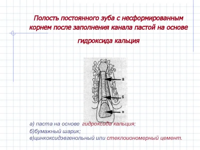 Полость постоянного зуба с несформированным корнем после заполнения канала пастой на основе