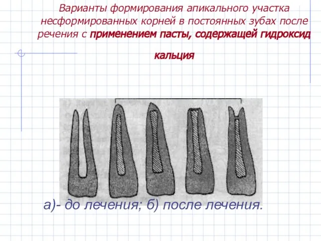 Варианты формирования апикального участка несформированных корней в постоянных зубах после речения с