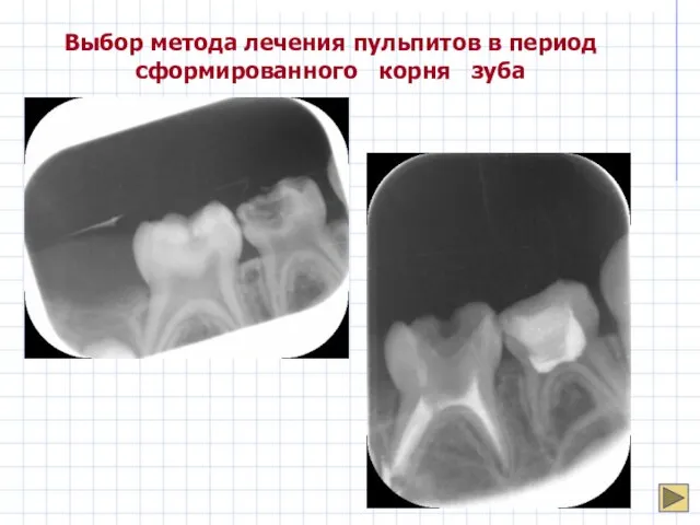 Выбор метода лечения пульпитов в период сформированного корня зуба