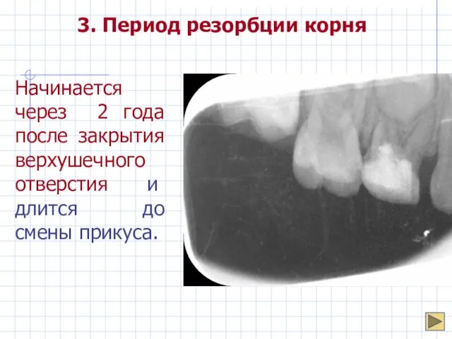 3. Период резорбции корня Начинается через 2 года после закрытия верхушечного отверстия