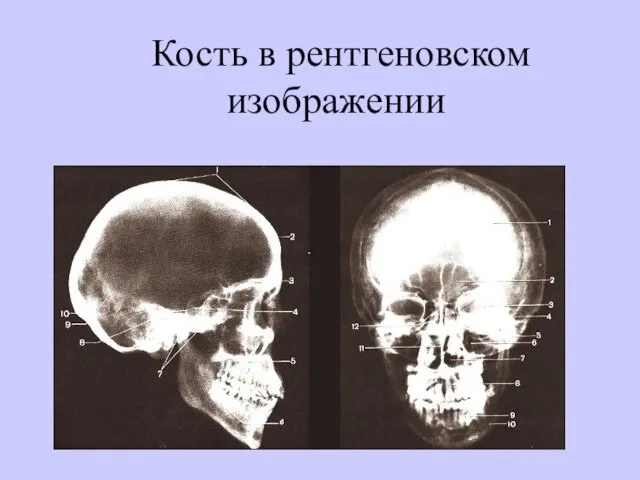 Кость в рентгеновском изображении
