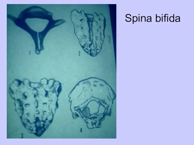 Spina bifida