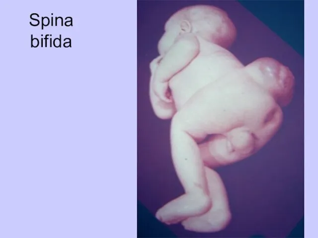 Spina bifida