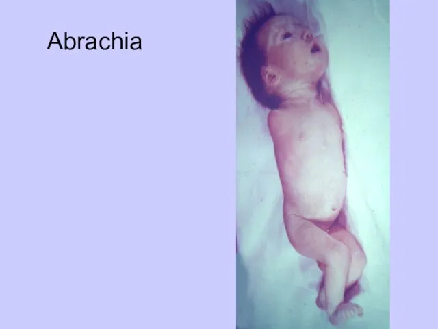 Abrachia