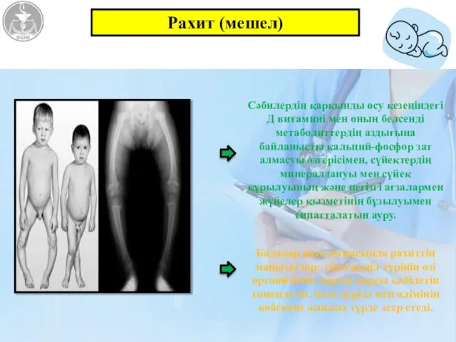 Сәбилердің қарқынды өсу кезеңіндегі Д витамині мен оның белсенді метаболиттердің аздығына байланысты