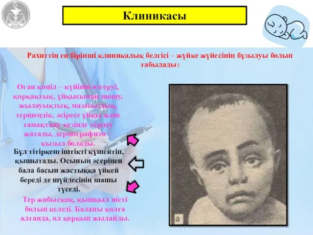 Клиникасы Рахиттің ең бірінші клиникалық белгісі – жүйке жүйесінің бұзылуы болып табылады: