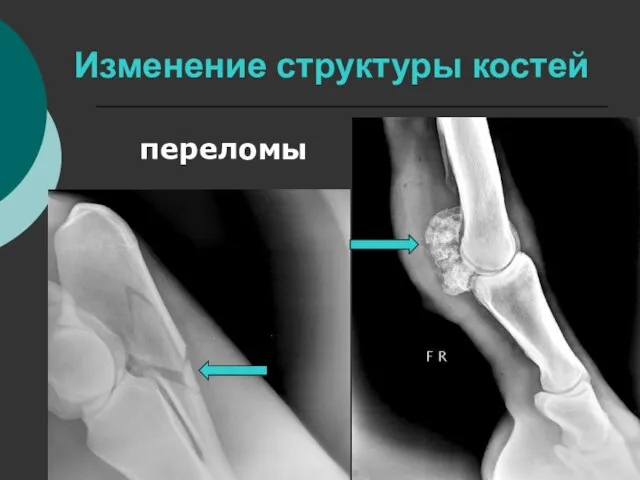 Изменение структуры костей переломы