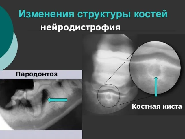 Изменения структуры костей нейродистрофия Костная киста Пародонтоз