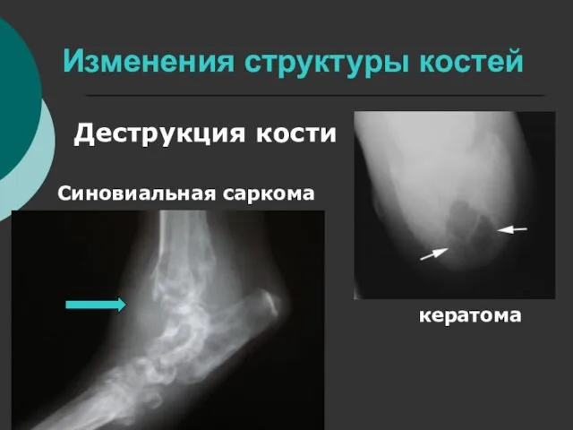Изменения структуры костей Деструкция кости кератома Синовиальная саркома