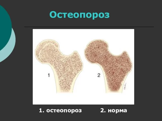 Остеопороз 1. остеопороз 2. норма
