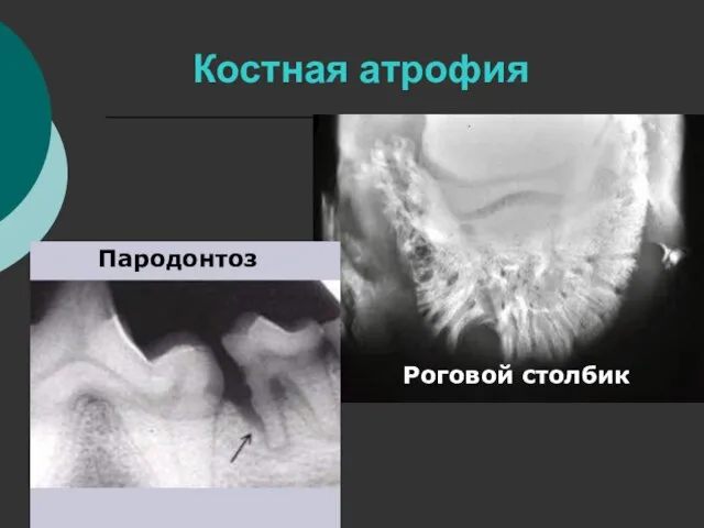 Костная атрофия Роговой столбик Пародонтоз