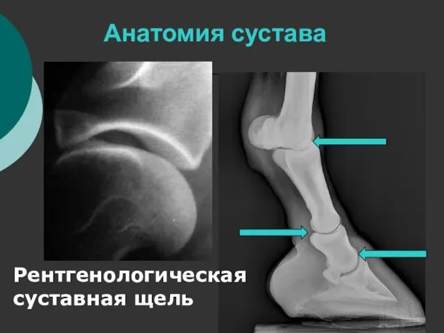 Анатомия сустава Рентгенологическая суставная щель