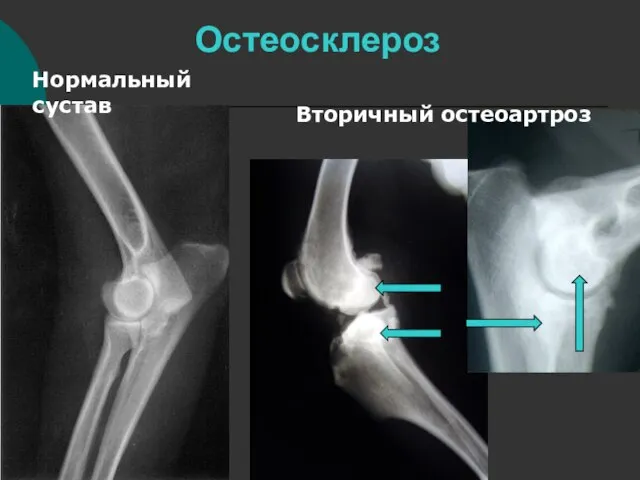 Остеосклероз Нормальный сустав Вторичный остеоартроз