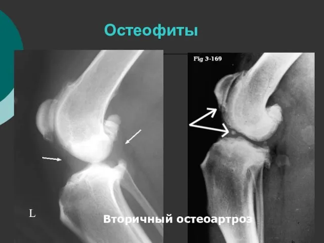Остеофиты Вторичный остеоартроз