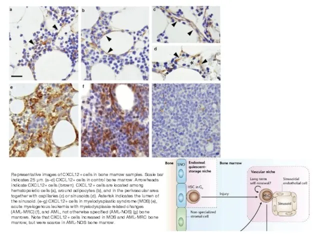 Representative images of CXCL12+ cells in bone marrow samples. Scale bar indicates