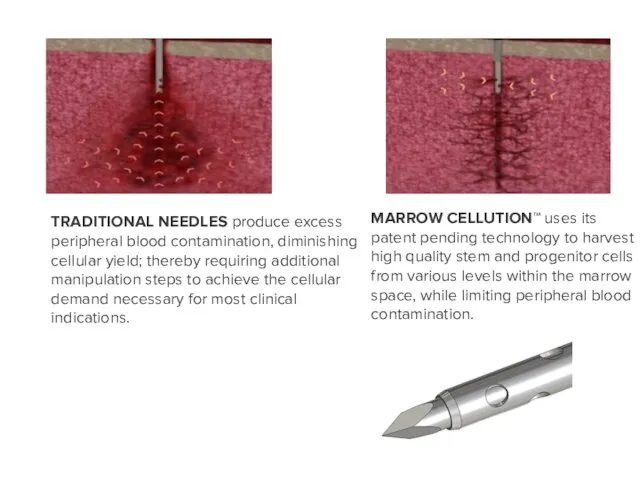 TRADITIONAL NEEDLES produce excess peripheral blood contamination, diminishing cellular yield; thereby requiring