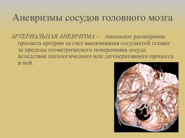 Аневризмы сосудов головного мозга АРТЕРИАЛЬНАЯ АНЕВРИЗМА - локальное расширение просвета артерии за