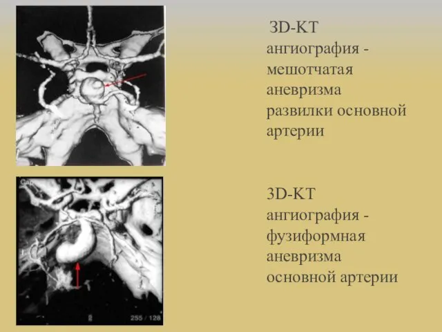 ЗD-KT ангиография - мешотчатая аневризма развилки основной артерии 3D-KT ангиография - фузиформная аневризма основной артерии