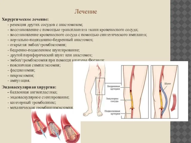 Лечение Хирургическое лечение: - резекция других сосудов с анастомозом; - восстановление с