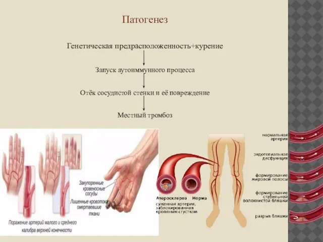 Патогенез Генетическая предрасположенность+курение Запуск аутоиммунного процесса Отёк сосудистой стенки и её повреждение Местный тромбоз