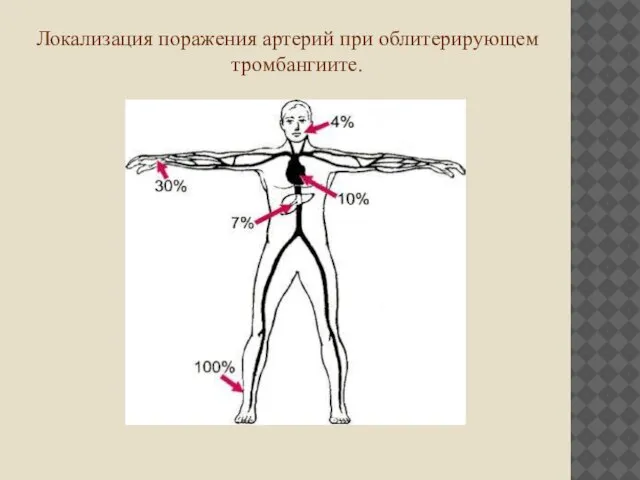 Локализация поражения артерий при облитерирующем тромбангиите.