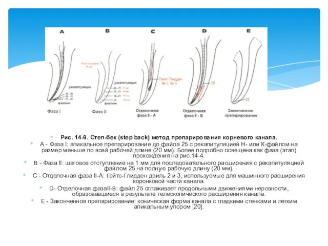 Рис. 14-9. Степ-бек (step back) метод препарирования корневого канала. А - Фаза