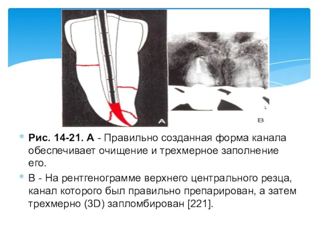 Рис. 14-21. А - Правильно созданная форма канала обеспечивает очищение и трехмерное