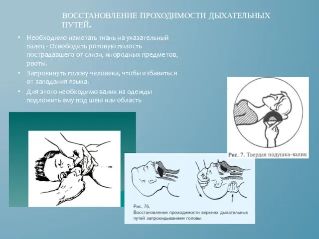 ВОССТАНОВЛЕНИЕ ПРОХОДИМОСТИ ДЫХАТЕЛЬНЫХ ПУТЕЙ. Необходимо намотать ткань на указательный палец - Освободить