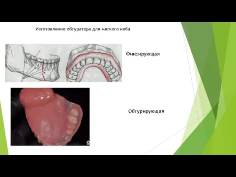 Фиксирующая Обтурирующая Изготовление обтуратора для мягкого неба