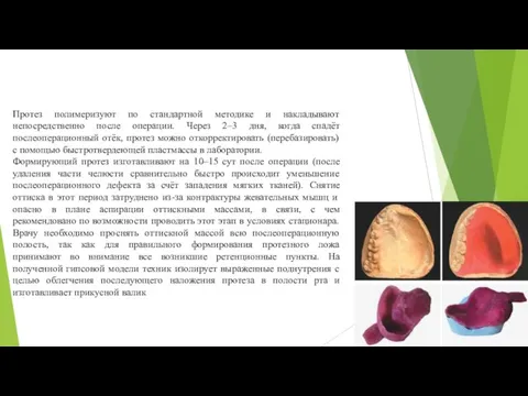 Протез полимеризуют по стандартной методике и накладывают непосредственно после операции. Через 2–3