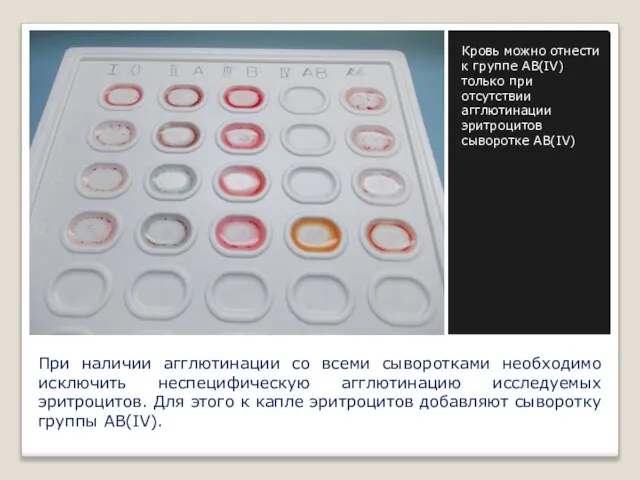 При наличии агглютинации со всеми сыворотками необходимо исключить неспецифическую агглютинацию исследуемых эритроцитов.