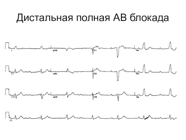 Дистальная полная АВ блокада