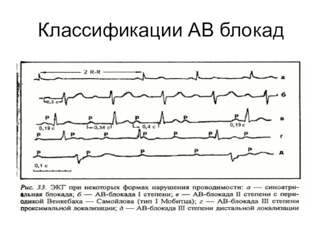 Классификации АВ блокад