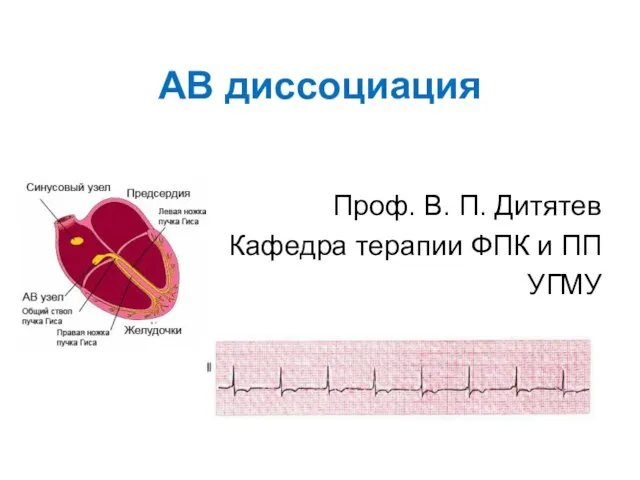 АВ диссоциация Проф. В. П. Дитятев Кафедра терапии ФПК и ПП УГМУ