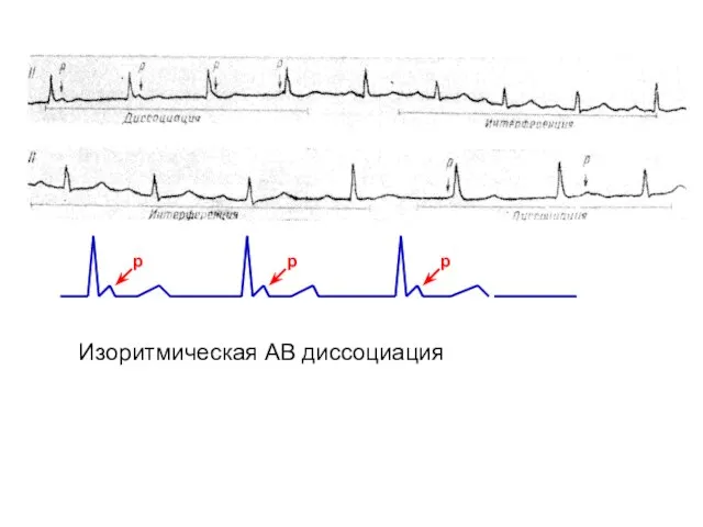 р р р Изоритмическая АВ диссоциация